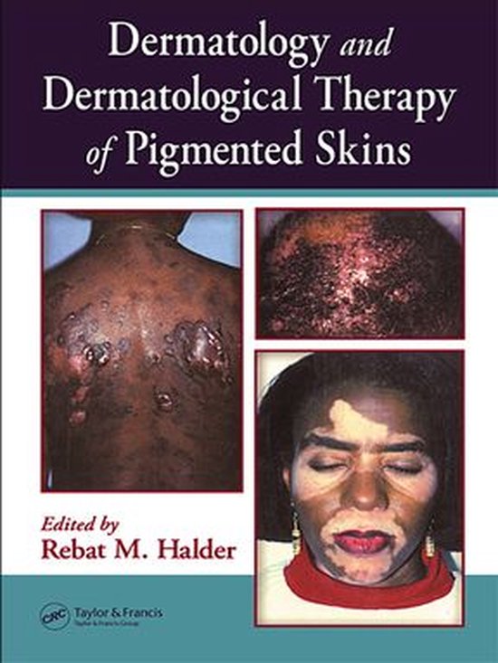 Dermatology and Dermatological Therapy of Pigmented Skins - cover