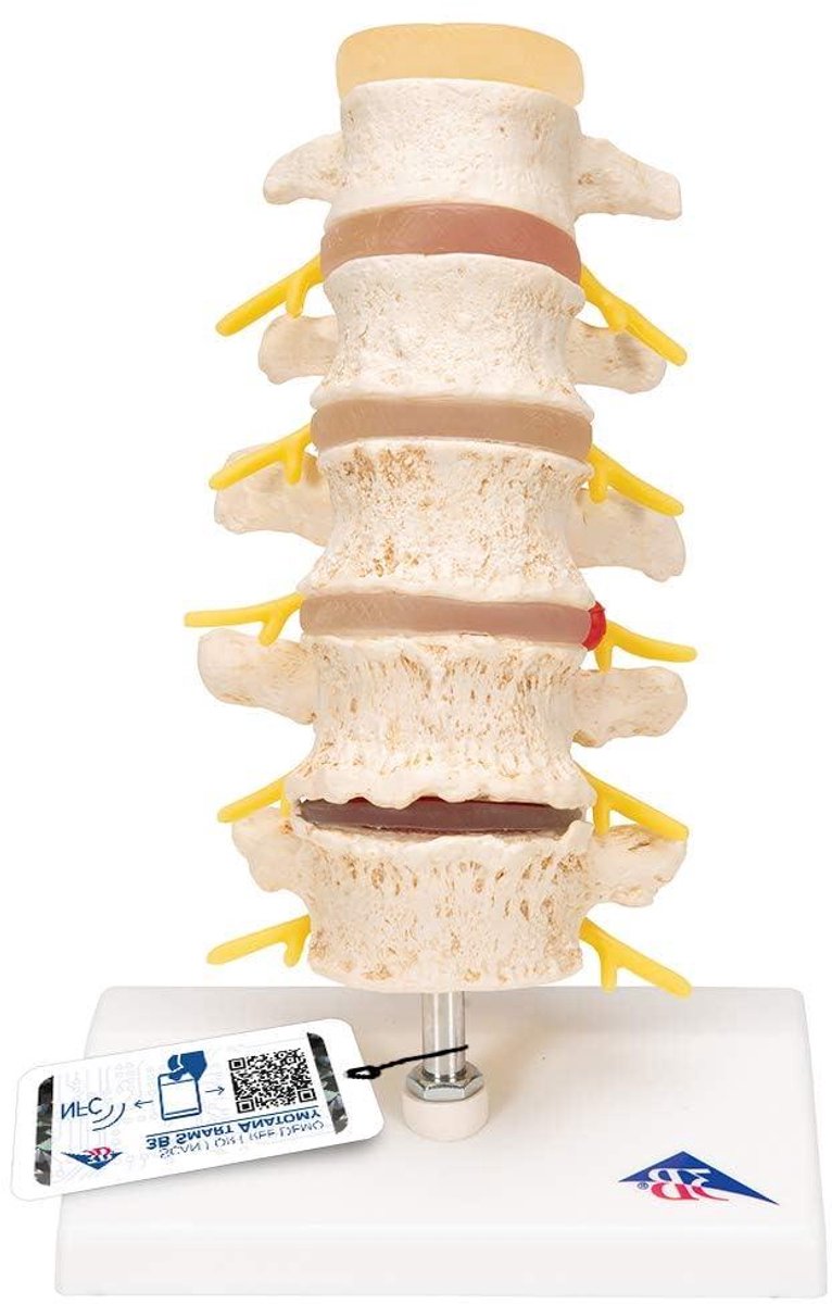 Wervelkolom Model - Rugmodel Educatie - Medisch Onderwijs - Degeneratieve Veranderingen - 23 x 13 x 13 cm