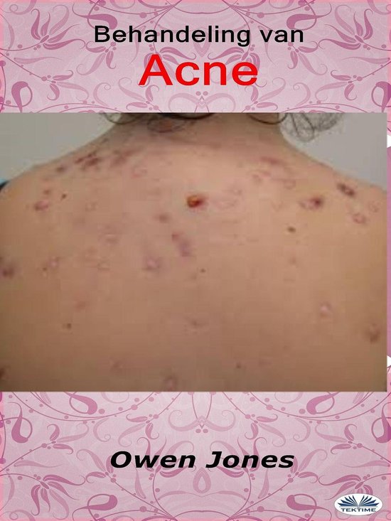 Behandeling Van Acne - cover