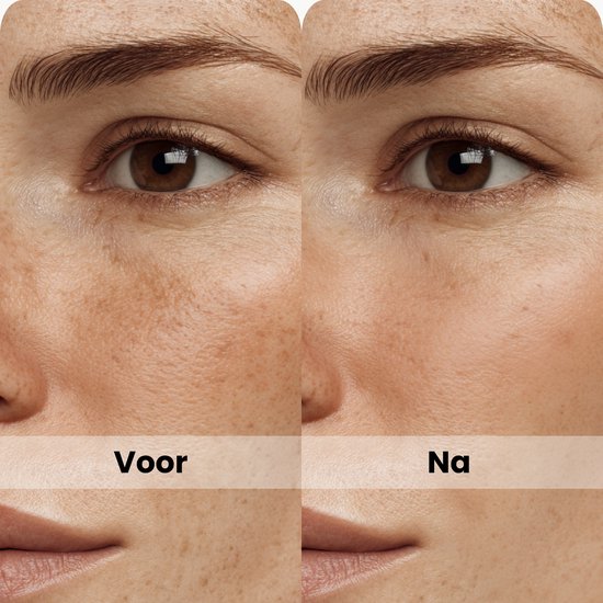 Skinlight Anti Pigment Creme - Melasma Creme - Hyperpigmentatie - Pigmentvlekken Verminderen - Ouderdomsvlekken - Brightening Cream - 60 ml