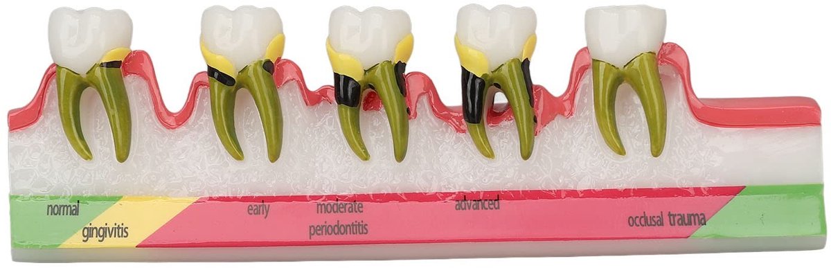 Dailygoods- Parodontitis Model - Hars - Weergavemodel - Tandheelkundige Aandoeningen - Gingivitis - Chronische Parodontitis - Duidelijke Weergave - Tandheelkundig Model
