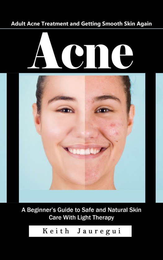 Acne: Adult Acne Treatment and Getting Smooth Skin Again (A  ... - cover