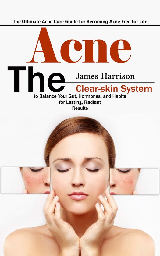 Acne: The Ultimate Acne Cure Guide for Becoming Acne Free fo ... - cover
