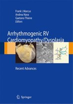 Arrhythmogenic right ventricular cardiomyopathy/dysplasia