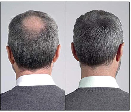 Vergelijking van achterkant van hoofd: kaal op links, voller haar op rechts na IMPERIO. Mannen met grijze haren.
