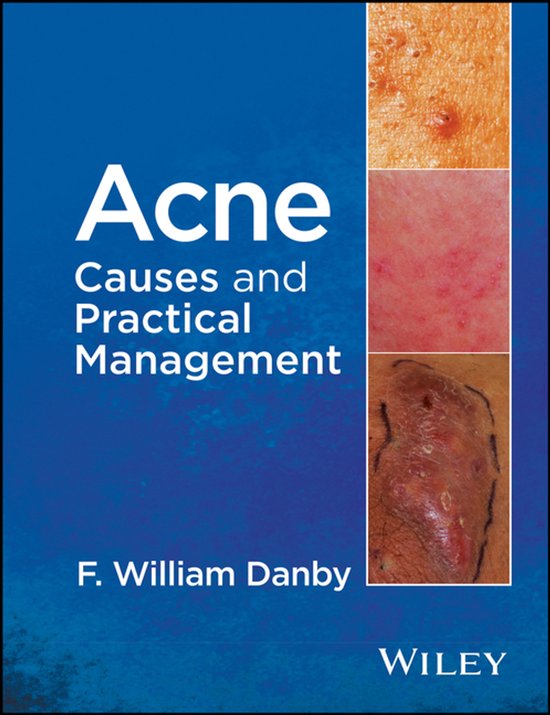 Acne - cover
