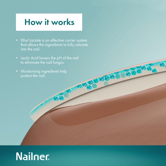 Nailner Kalknagelkwastje 5 ml - Kalknagelbehandeling voor Kalknagel en Schimmelnagel, Medische hulpmiddelen om Kalknagels te behandelen en voorkomen, effectief binnen 4 weken, eenvoudig aan te brengen zonder te vijlen, voor dagelijks gebruik