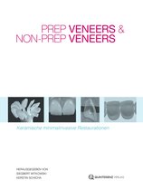 Prep Veneers und Non-Prep Veneers