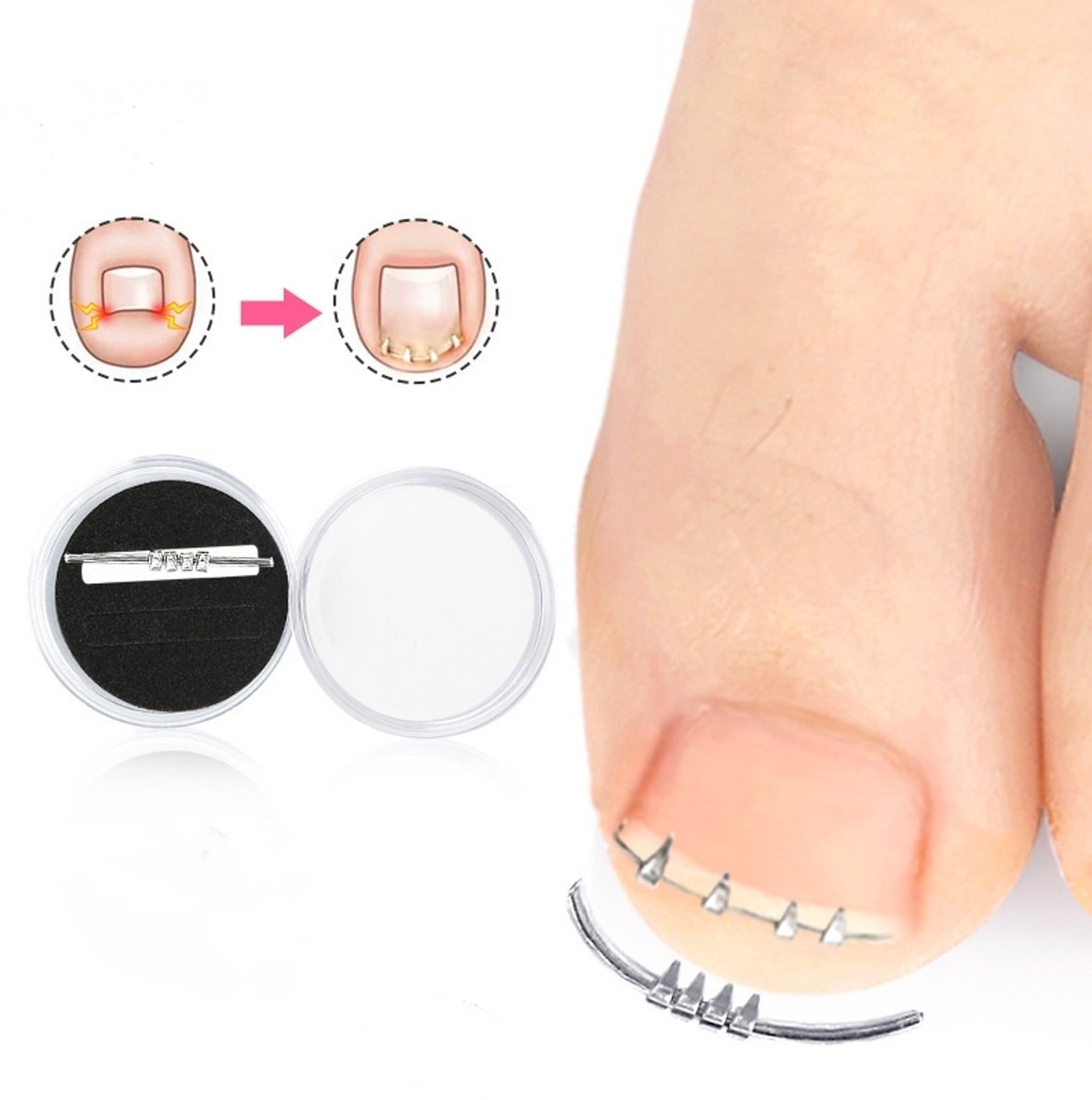 Corrector voor ingegroeide teennagels
