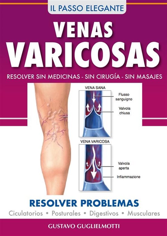Venas Varicosas - Solución definitiva - cover