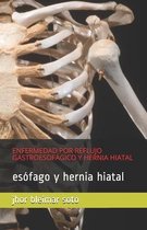 Enfermedad Por Reflujo Gastroesofagico Y Hernia Hiatal