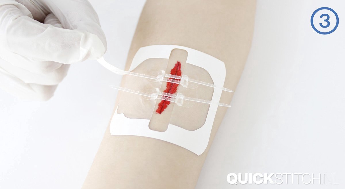 Goedkoopste QuickStitch™ dubbele Hechtpleister – Naaldloze Hechting – noodhechting - pleister voor diepe wonden - pleisters – zelf hechtpleister – snelle manier om wonden af te sluiten – NU 5 stuks!