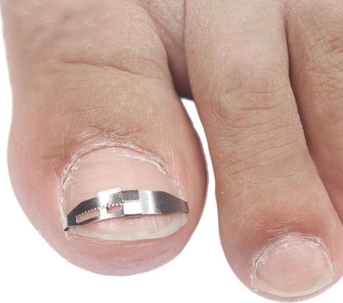 Ingroeiende teennagel pedicuretool voor correctie van dikke teennagels - RVS-clip en gebogen klem voor paronychia-behandeling