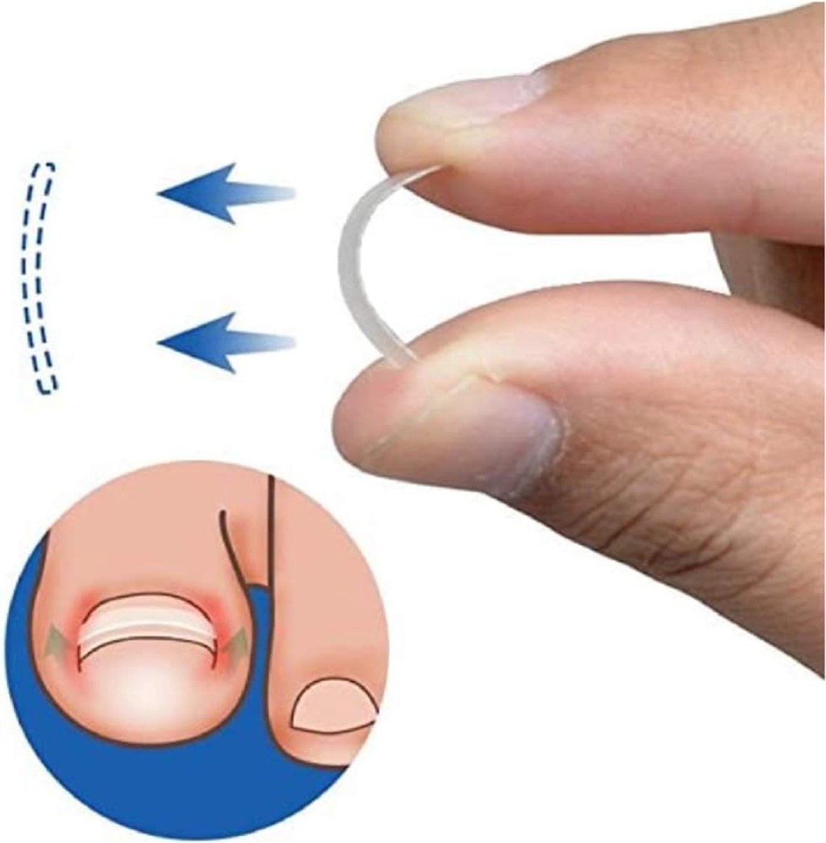 SnelShoppen - Ingrown Toenail Smoothing Clip Curved Bs Bracket - Nagelcorrectie Tool voor Dikke Teennagels - Transparante Nagelrechtzetter - 10 Stuks