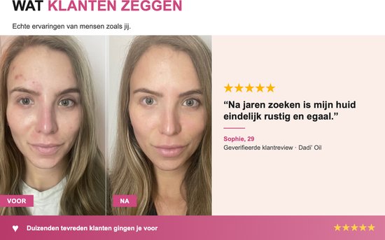 Twee afbeeldingen van dezelfde vrouw: links 'voor' met rode, onrustige huid, rechts 'na' met een rustige, egale huid.