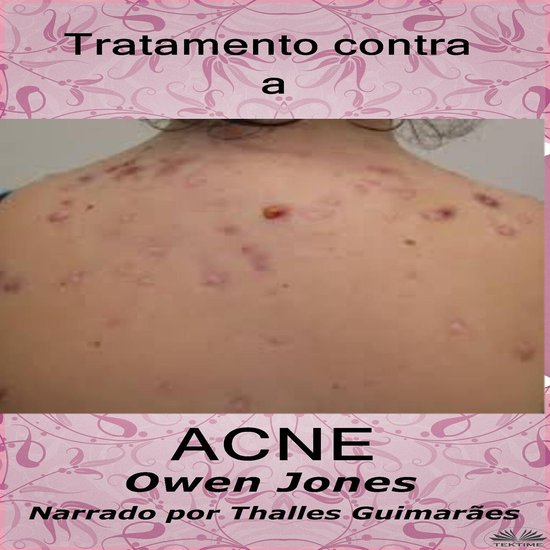 Tratamento Contra A Acne - cover