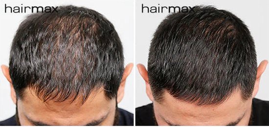 HairMax Laser 272 PowerFlex (model 2023) - Hairmax