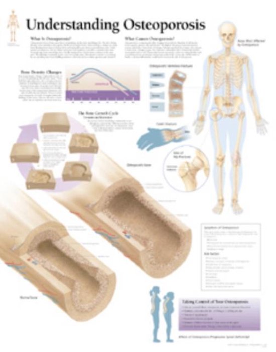 Foto: Understanding osteoporosis laminated poster