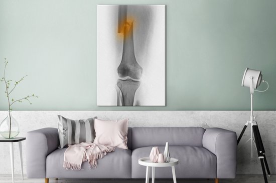 Radiographie de la cuisse d'un homme de 30 ans impliqué dans un accident de moto 80x120 cm - Tirage photo sur toile (Décoration murale salon / chambre)