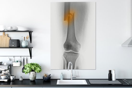 Radiographie de la cuisse d'un homme de 30 ans impliqué dans un accident de moto 80x120 cm - Tirage photo sur toile (Décoration murale salon / chambre)