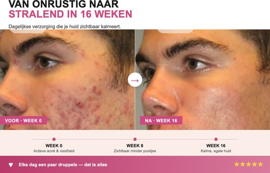 Twee profielafbeeldingen van Jens: links 'week 0' met acné en roodheid, rechts 'week 16' met kalme, egale huid.