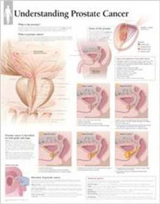 Foto: Understanding prostate cancer laminated poster