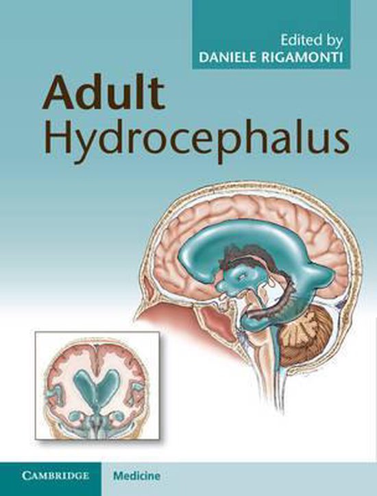 Foto: Adult hydrocephalus