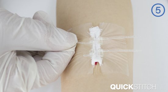 QuickStitch dubbele Hechtpleister – Naaldloze Hechting – pleister voor