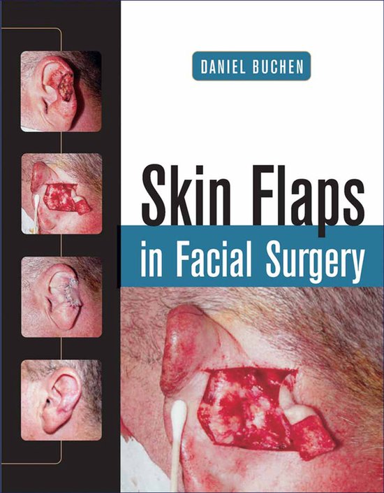 Skin Flaps In Facial Surgery - cover