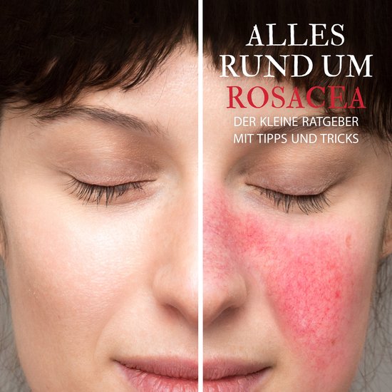 Alles Rund um Rosacea - Der kleine Ratgeber mit Tipps und Tr ... - cover