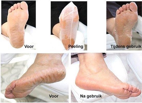 Eelt sokken + Voetcrèm 50ML -Huid verzorging-Eelt verwijderaar-Eeltsokken-  Eelt... | bol