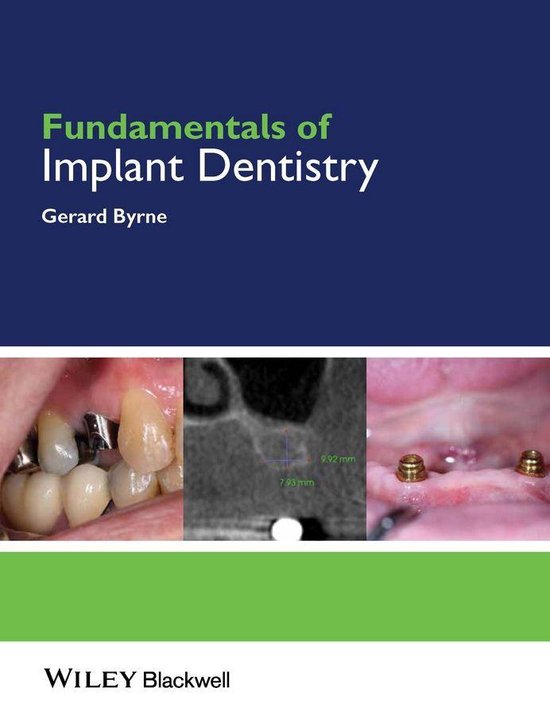 Fundamentals (Dentistry) - Fundamentals of Implant Dentistry (ebook ...