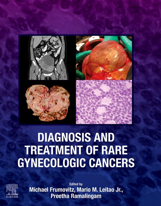Diagnosis and Treatment of Rare Gynecologic Cancers (ebook), Michael