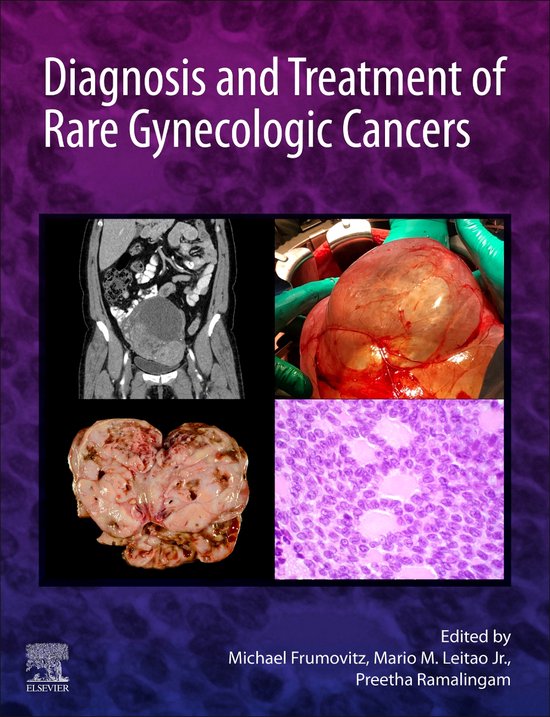 Diagnosis and Treatment of Rare Gynecologic Cancers EBook (ebook