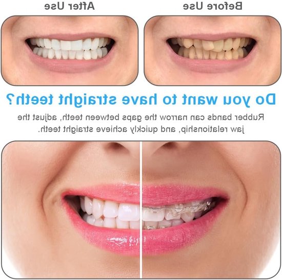 Orthodontische Rubber Bands Mix van 500 Stuks - Elastische Tandbanden met 5 Plaatsingstools voor Beugels en Tandcorrectie van Merkloos — afbeelding 4