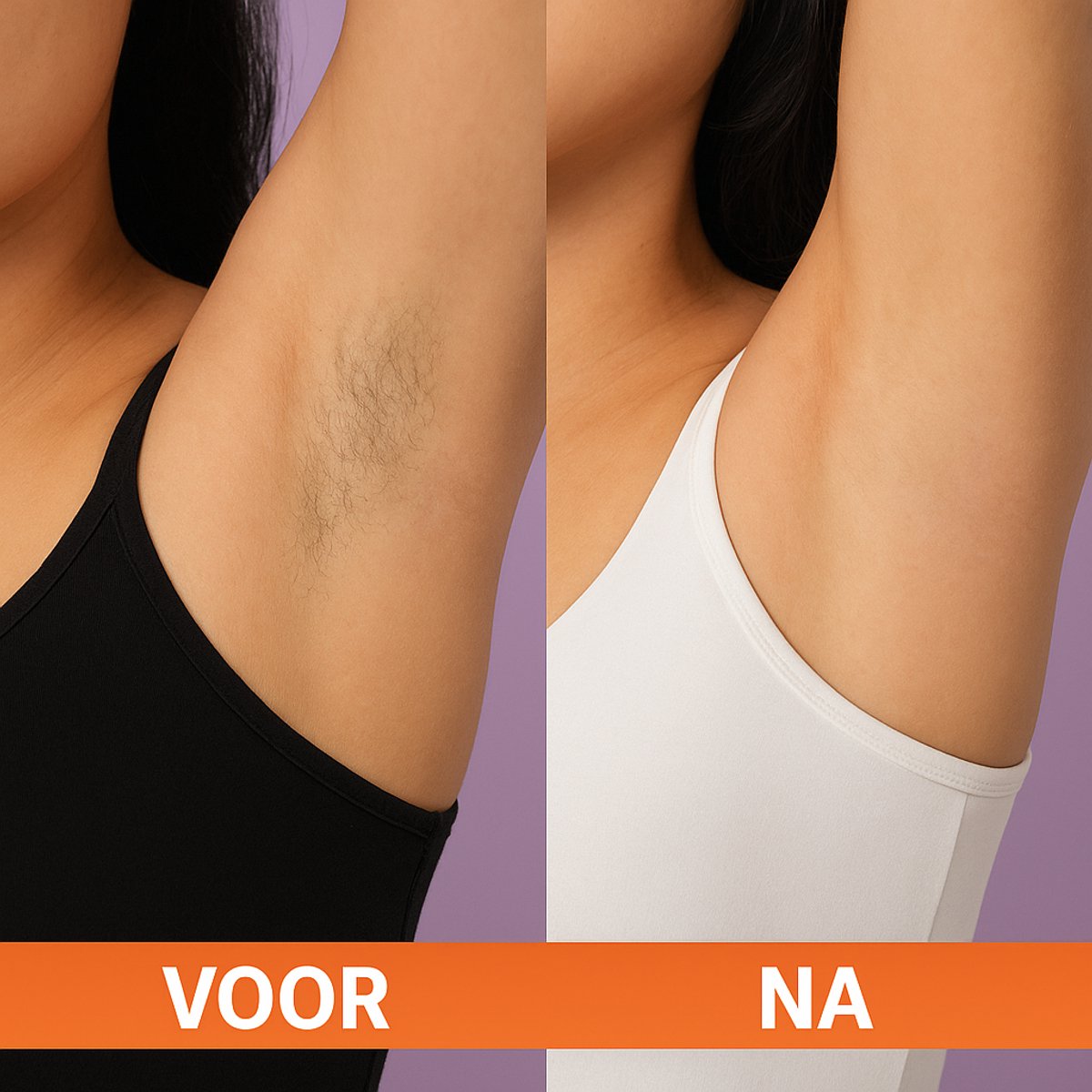 IPL - Permanente Ontharing met Ijskoeling thumbnail 5