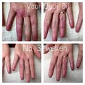 Voor- en nafoto's van handen die behandeld zijn met Dadi'Oil gedurende 3 weken.