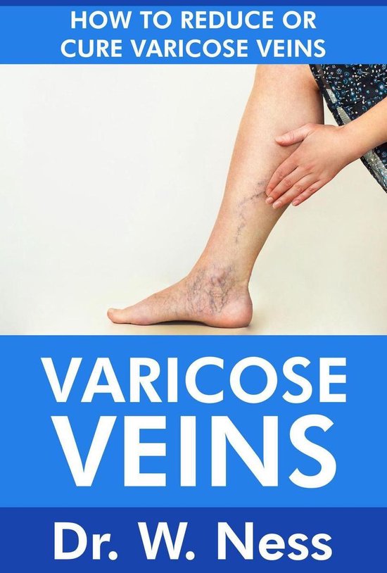 Varicose Veins: How To Reduce Or Cure Varicose Veins - cover