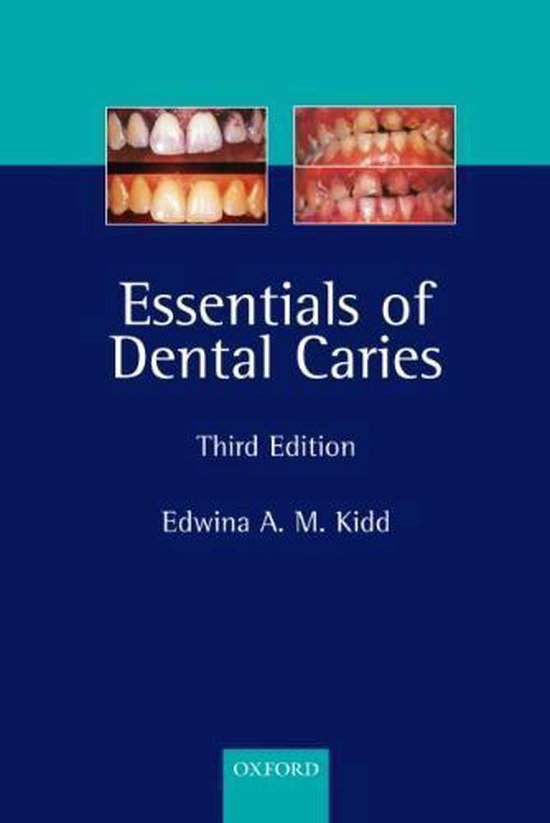 Essentials Of Dental Caries
