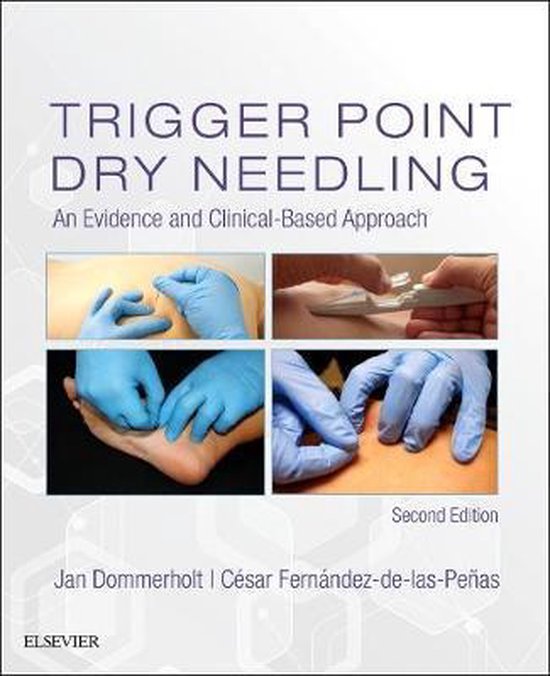 Foto: Trigger point dry needling