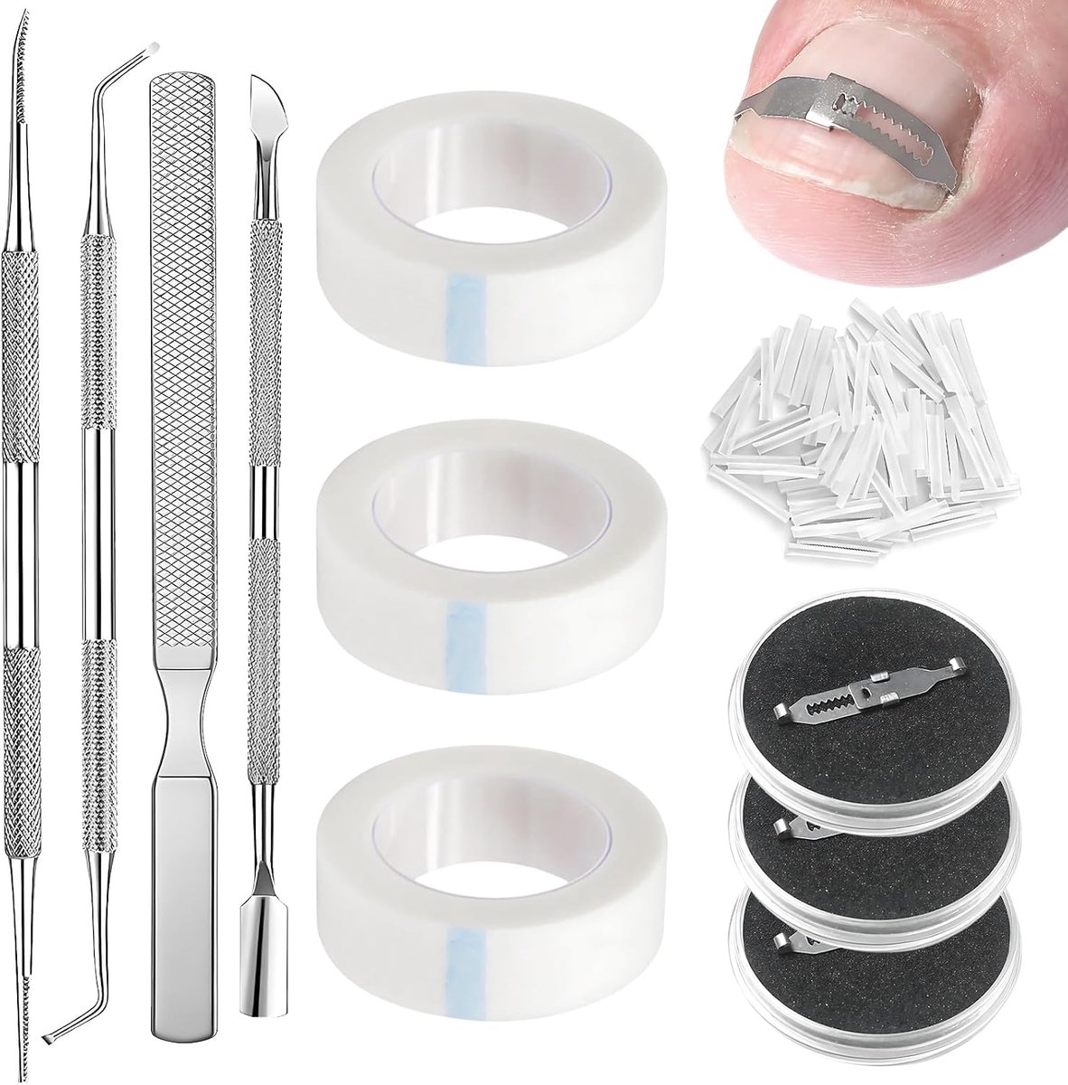 Toenail correction set - 200 stuk - rvs nagelcorrectieclips - professioneel ingegroeide teennagels verzorgen - ShopVlot