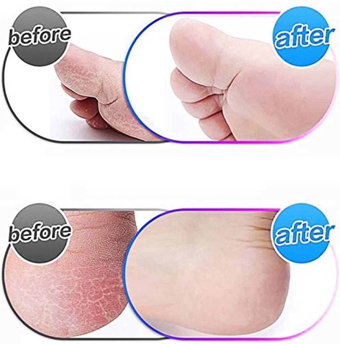 Thijox - 5 Pcs Rollers voor Elektrische Voetvijl, Pedicure Hard Skin Remover met Harde Micro-Diamantkristallen, Vervangingsrollen voor Zachte Voeten
