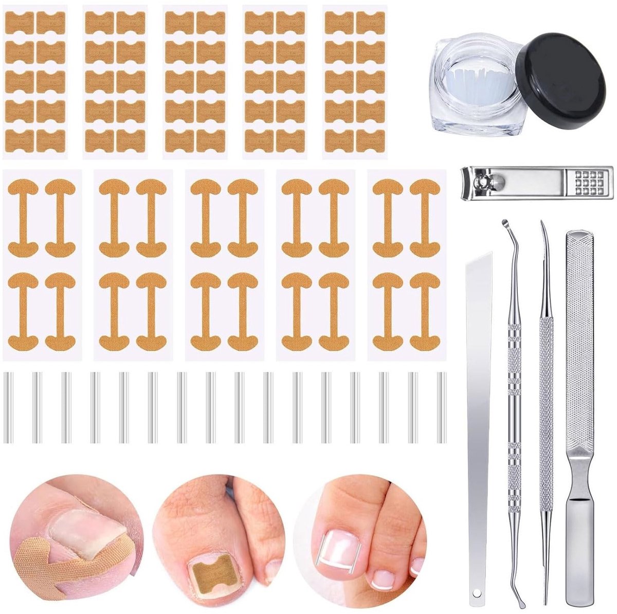 Dailygoods- Ingegroeide Teennagels Corrector - Pijnvrije Teennagels - C-vormige Vulling - Set voor Correctie - Hoogwaardige Materialen - Comfortabel Gebruik - Teennagelcorrectieset