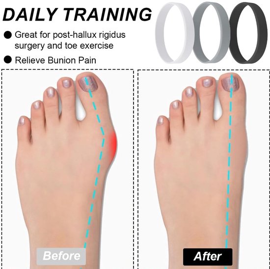 Hallux Valgus Orthese - 3-delige Teenz separator voor mannen en vrouwen, bescherming tegen overlappende tenen, bunion corrector en voetuitlijning — afbeelding 4