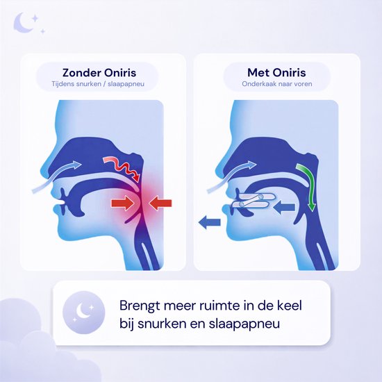 Diagrammen tonen neus- en keelpassage: zonder Oniris (snurken) en met Oniris (onderkaak naar voren).