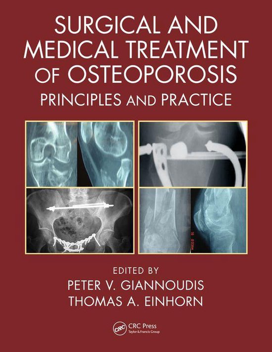 Surgical and Medical Treatment of Osteoporosis - cover
