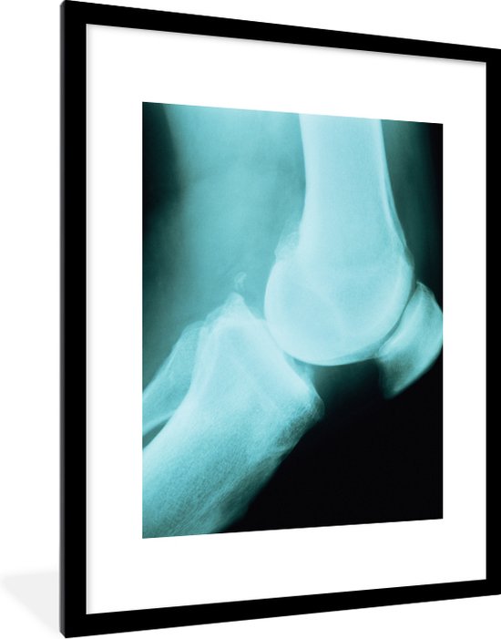 Fotolijst incl. Poster Een röntgenfoto van een Artritis knie 60x80 cm Posterlijst