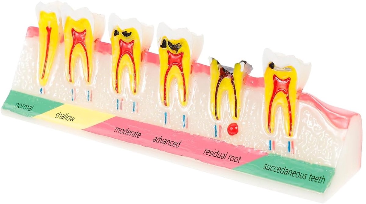 Tandheelkundig Model - Lesmodel Gebit - Onderwijs Demonstratie - Verwijderbare Tanden - 15 cm - Wit
