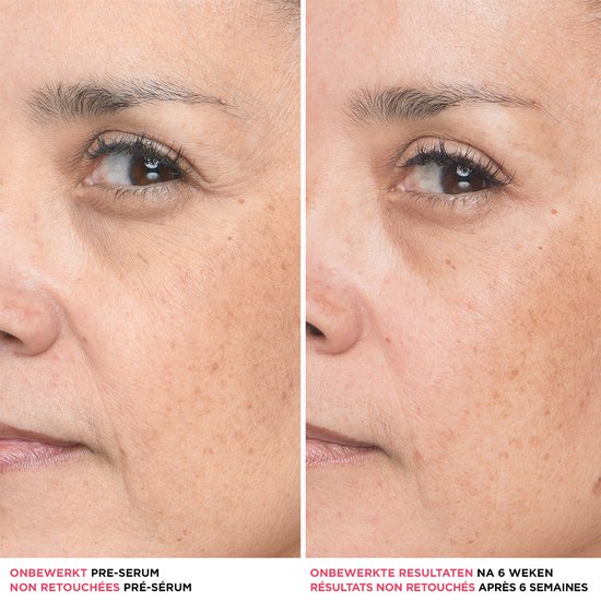 Voor-en-na foto van een gezichtsdeel met rimpels. Links 'Onbewerkt Pre-serum', rechts 'Onbewerkte resultaten na 6 weken'.