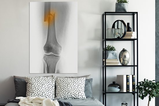 Radiographie de la cuisse d'un homme de 30 ans impliqué dans un accident de moto 80x120 cm - Tirage photo sur toile (Décoration murale salon / chambre)